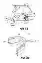 Fig. 85 - Obstructive sleep apnea treatment devices, systems and methods