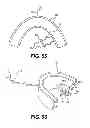 Fig. 86 - Obstructive sleep apnea treatment devices, systems and methods