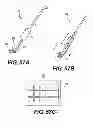 Fig. 87 - Obstructive sleep apnea treatment devices, systems and methods