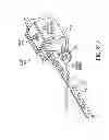 Fig. 91 - Obstructive sleep apnea treatment devices, systems and methods