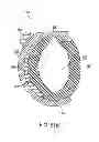 Fig. 92 - Obstructive sleep apnea treatment devices, systems and methods