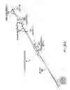 Fig. 93 - Obstructive sleep apnea treatment devices, systems and methods
