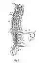 Fig. 03 - Implantable lead with braided conductors