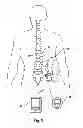 Fig. 04 - Implantable lead with braided conductors