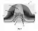 Fig. 03 - Vestibular stimulation electrode
