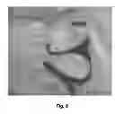 Fig. 06 - Vestibular stimulation electrode
