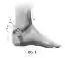 Fig. 02 - Apparatus for transcutaneous electrical stimulation of the tibial nerve