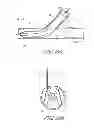 Fig. 15 - Vascular bifurcation prosthesis