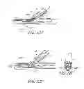 Fig. 17 - Vascular bifurcation prosthesis