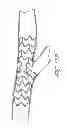 Fig. 20 - Vascular bifurcation prosthesis