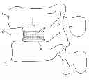 Fig. 01 - Expandable fusion device and method of installation thereof