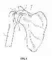 Fig. 02 - MULTI-COMPONENT SHOULDER IMPLANT ASSEMBLY WITH DUAL ARTICULATING SURFACES