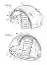 Fig. 03 - Artificial wear resistant plug for mounting to existing joint bone