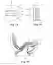 Fig. 09 - PROSTHETIC IMPLANTS FOR TOTAL KNEE ARTHROPLASTY