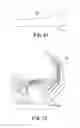 Fig. 11 - PROSTHETIC IMPLANTS FOR TOTAL KNEE ARTHROPLASTY