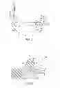 Fig. 04 - Posterior stabilized orthopaedic prosthesis
