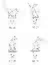 Fig. 13 - Posterior stabilized orthopaedic prosthesis
