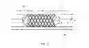 Fig. 07 - Implant for tissue lifting
