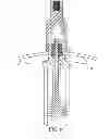 Fig. 12 - Transdermal prosthesis