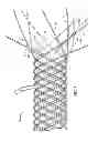 Fig. 02 - Methods for manufacturing secured strand end devices