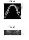 Fig. 08 - Method for periodontal disease measurement