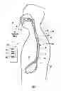 Fig. 02 - Device with passive valve to block emesis and/or reflux and associated system and method