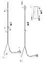 Fig. 05 - Device to block emesis and reflux and associated system and method