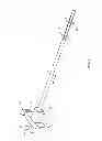 Fig. 02 - Cannula with image markers to indicate expandable device size