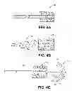 Fig. 05 - METHODS AND DEVICES FOR OCCLUDING AN OVARIAN PATHWAY