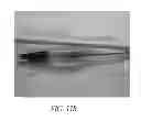 Fig. 49 - Adjustable connector, improved fluid flow and reduced clotting risk