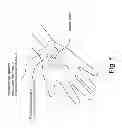 Fig. 02 - CARPAL TUNNEL RELIEF DEVICE