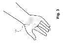 Fig. 04 - CARPAL TUNNEL RELIEF DEVICE