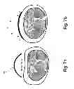 Fig. 08 - CARPAL TUNNEL RELIEF DEVICE