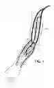 Fig. 02 - ARTERIOVENOUS ACCESS VALVE SYSTEM AND PROCESS