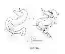 Fig. 02 - Devices and methods for forming an anastomosis