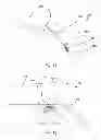 Fig. 07 - Adjustable glaucoma implant