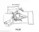 Fig. 08 - Positioning device for ankle joint replacement surgery
