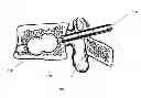 Fig. 01 - Biologic balloon and method of use