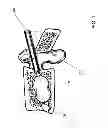 Fig. 02 - Biologic balloon and method of use