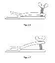 Fig. 07 - Apparatus for removing devices implanted in the body