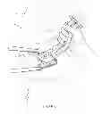 Fig. 08 - Apparatus for removing devices implanted in the body