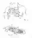 Fig. 02 - Method for the implantation of active fixation medical leads