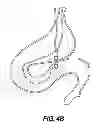 Fig. 06 - Self-assembling magnetic anastomosis device having an exoskeleton