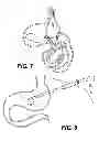Fig. 08 - Self-assembling magnetic anastomosis device having an exoskeleton