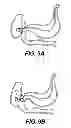 Fig. 09 - Self-assembling magnetic anastomosis device having an exoskeleton