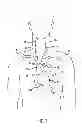Fig. 02 - Anti-embolic device and method