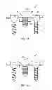 Fig. 08 - Variable angle bone plate with semi-constrained articulating screw