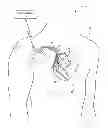 Fig. 01 - Criteria for optimal electrical resynchronization during fusion pacing
