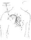 Fig. 01 - Criteria for optimal electrical resynchronization during fusion pacing
