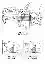 Fig. 02 - Method of stimulating a hypoglossal nerve for controlling the position of a patient's tongue